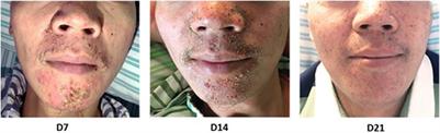 Reducing Acneiform Rash Induced by EGFR Inhibitors With Honeysuckle Therapy: A Prospective, Randomized, Controlled Study